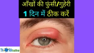 Read more about the article आँखों में फुंसी/गुहेरी का इलाज | Eye Stye Treatment In Hindi