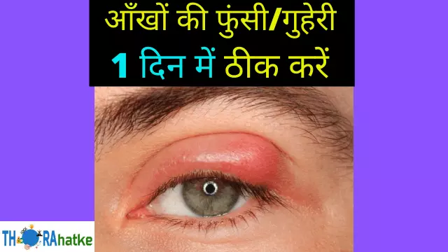 You are currently viewing आँखों में फुंसी/गुहेरी का इलाज | Eye Stye Treatment In Hindi
