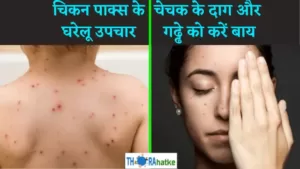 Read more about the article चेचक के दाग़ और गढ्ढे को जड़ से हटायें- About chicken pox in hindi