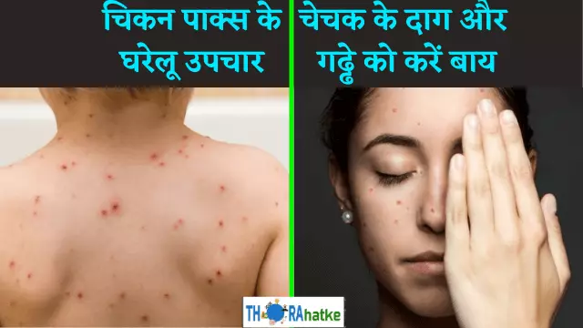 You are currently viewing चेचक के दाग़ और गढ्ढे को जड़ से हटायें- About chicken pox in hindi