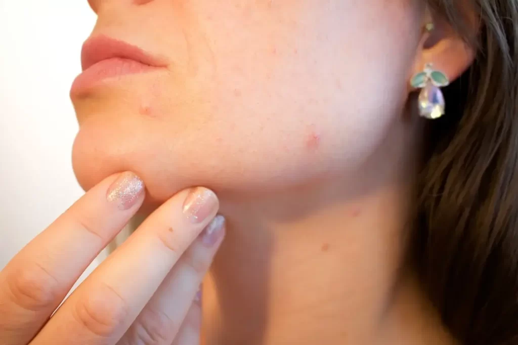 कील मुहांसे/पिंपल्स के कारण ( What Causes Pimple In Hindi )