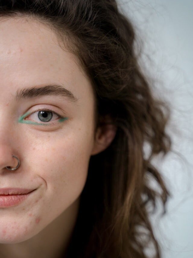 Read more about the article चेहरे के गड्ढे भरने के तरीके-large Open Pores treatment in Hindi