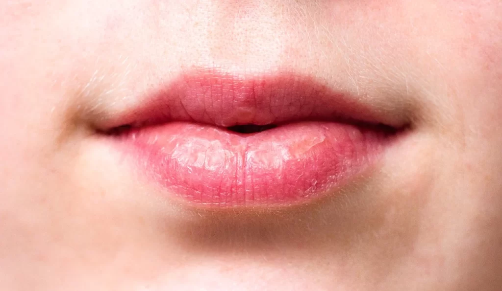 होंठ फटने का घरेलू उपाय (Dry Lips Home Remedy In Hindi)-How to cure chapped lips fast