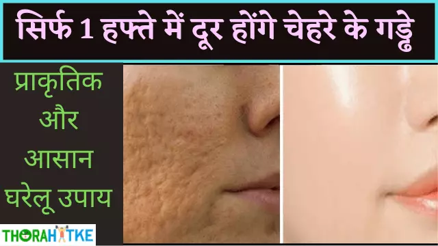 You are currently viewing 1 हफ्ते में चेहरे के गड्ढे भरने के तरीके | Open Pores Treatment in Hindi
