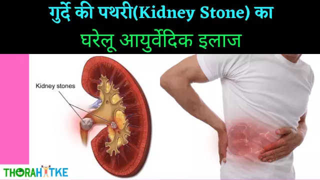 Read more about the article बिना ऑपरेशन पथरी का इलाज | Kidney Stone Treatment In Hindi