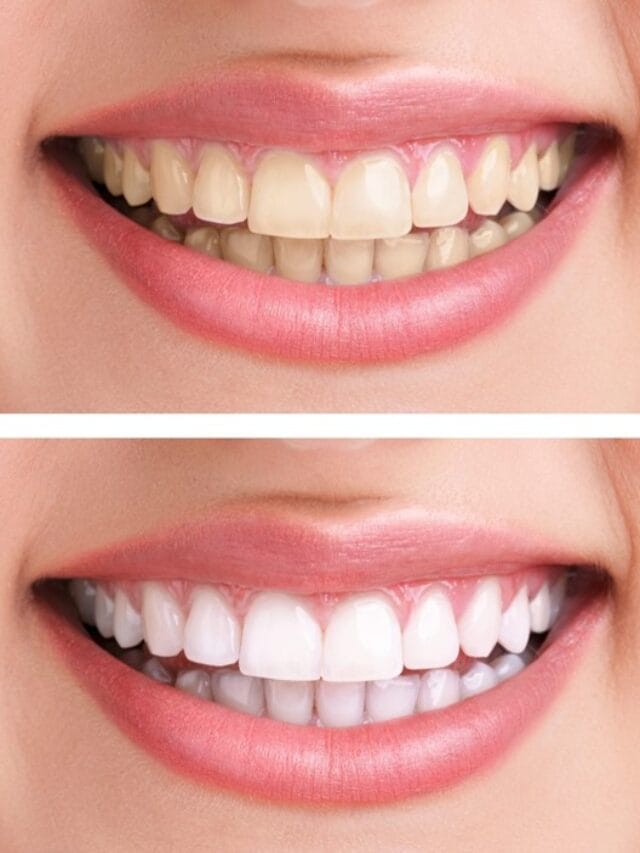 Read more about the article Teeth ko white kaise kare