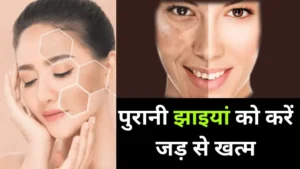 Read more about the article चेहरे की झाइयां जड़ से खत्म करे ये उपाय – jhaiya kaise hataye
