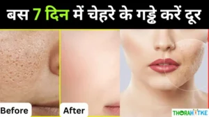 Read more about the article चेहरे के गड्ढे मिटाएं चुटकी में- chehre ke gadde kaise bhare