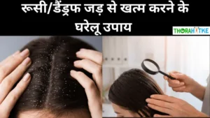 Read more about the article रूसी या डैंड्रफ का रामबाण इलाज- Dandruff solution hindi