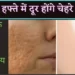 चेहरे-के-गड्ढे-भरने-के-तरीके-चेहरे-के-गड्ढे-हटाने-की-क्रीम-का-नाम-Open-Pores-treatment-in-Hindi